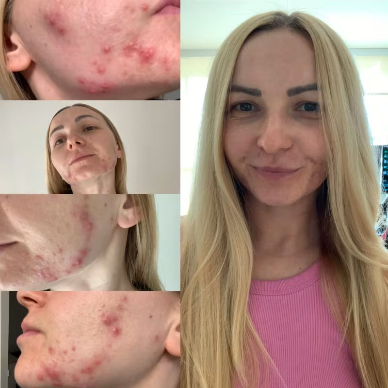 Woman with acne on her face, shown in a collage with close-up shots.